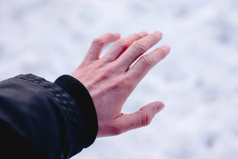 zimne dłonie przyczyny