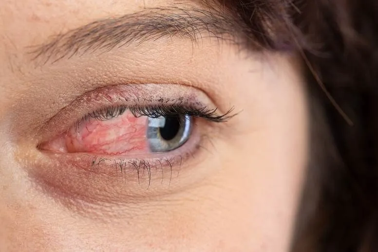 Trądzik różowaty oczny – jakie są objawy i jak go leczyć?