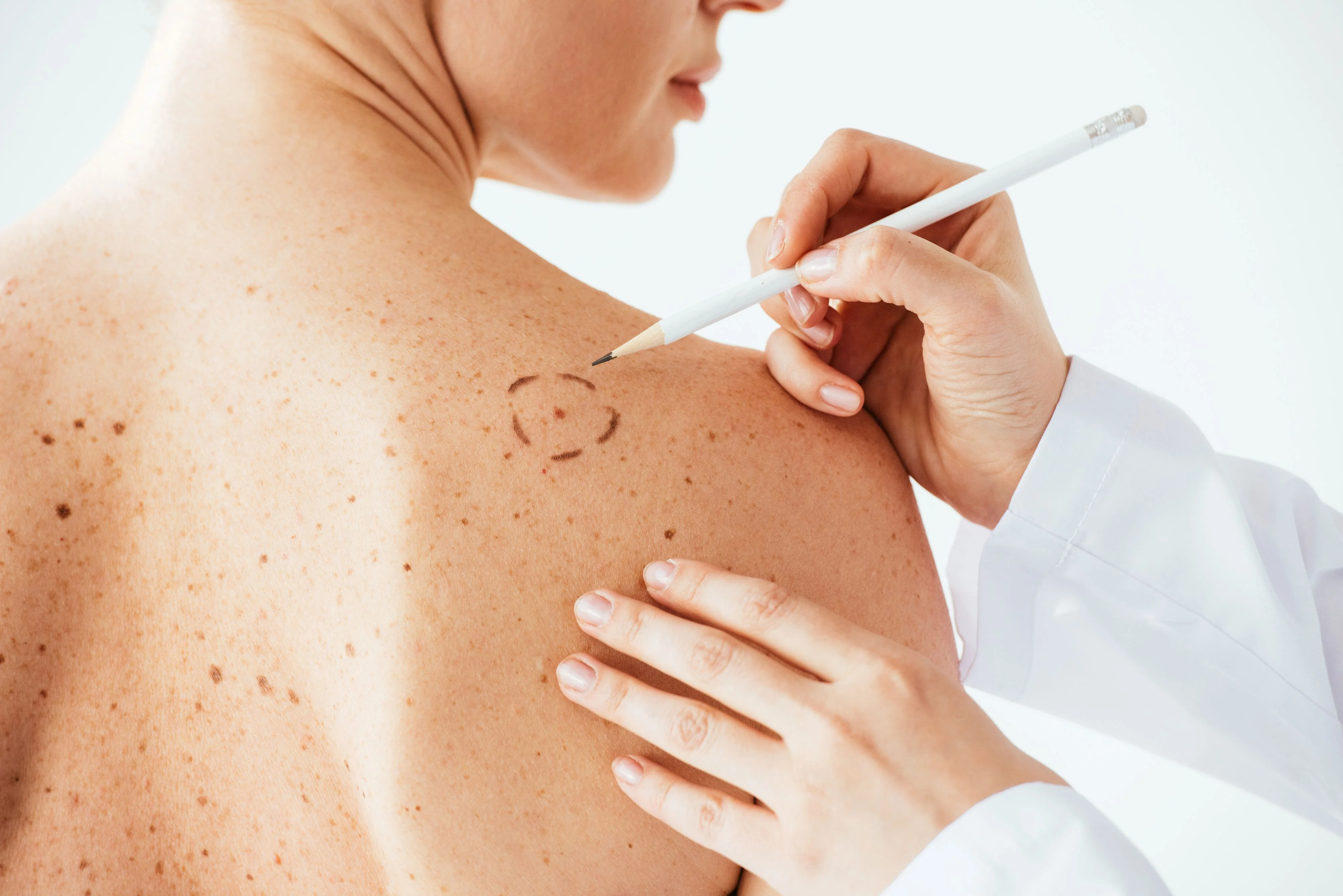 Biopsja skóry − co to jest? Biopsja skóry − co to jest?