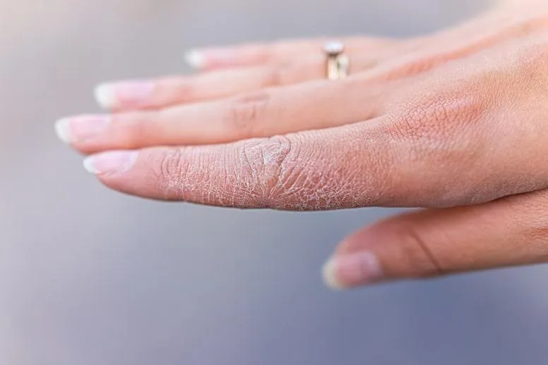 Pękająca skóra na dłoniach – jakie są przyczyny i jak temu zaradzić?