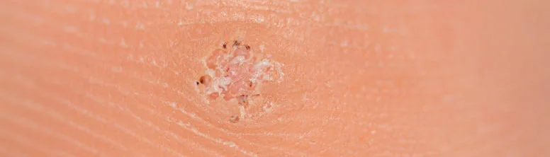 hpv na stopie hpv na stopie