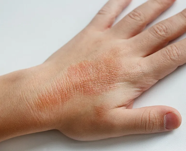 atopowe zapalenie skóry dłoni