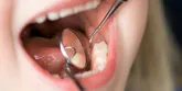 Ozonowanie zębów. Bezbolesne leczenie próchnicy u dzieci?