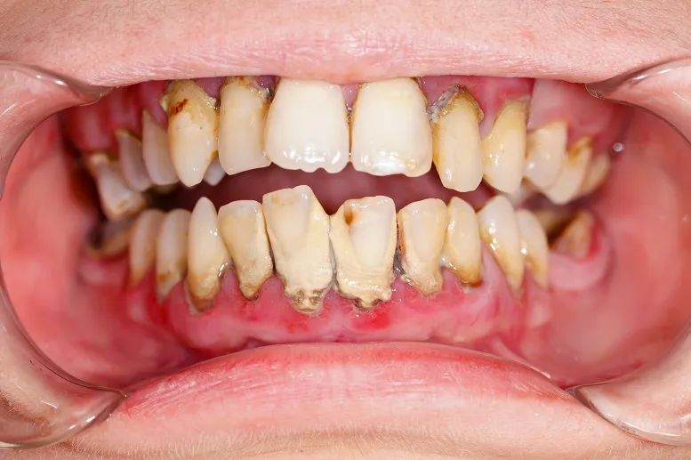 fluoroza zębów objawy