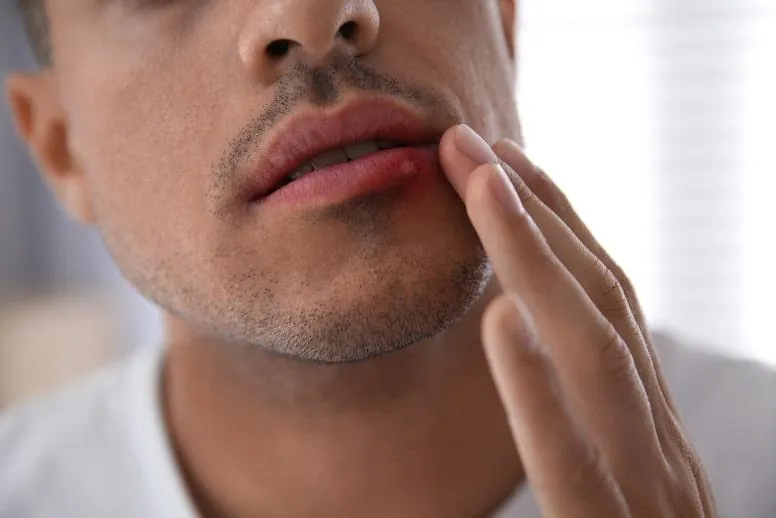 Owrzodzenia jamy ustnej – przyczyny, objawy i leczenie