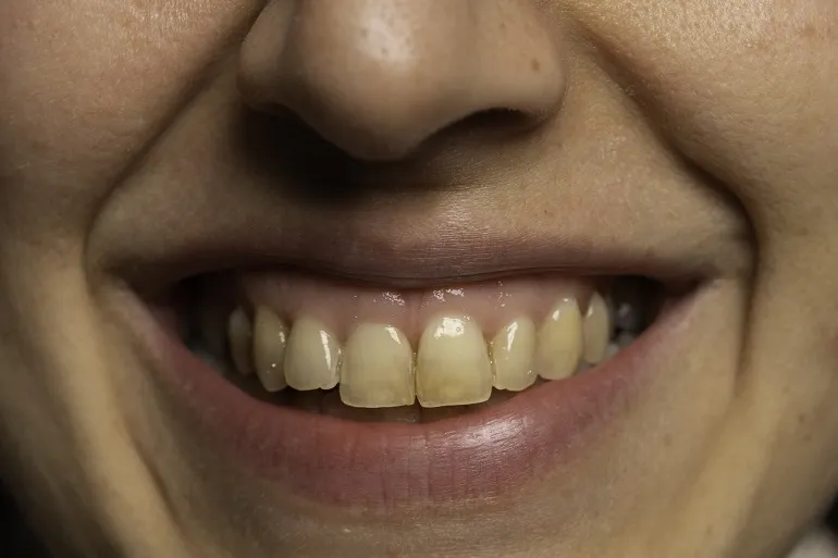 hipoplazja szkliwa zębowego
