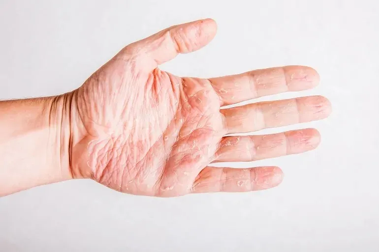 pękająca skóra między palcami - zła pielęgnacja