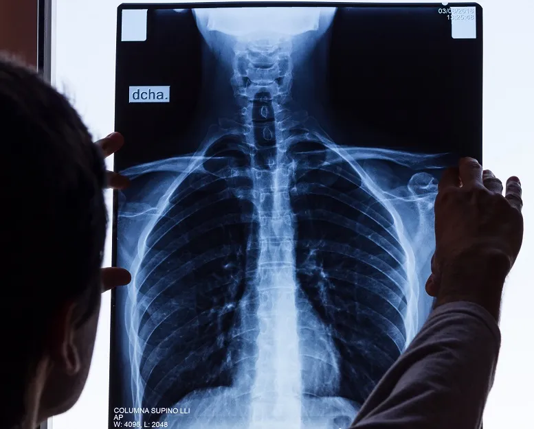 ból przy oddychaniu - rentgen klatki piersiowej