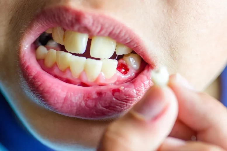 Co się dzieje po usunięciu zęba
