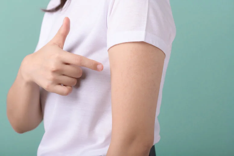 Rogowacenie okołomieszkowe (keratosis pilaris) – objawy, przyczyny i leczenie