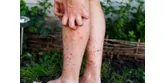 Czerwone kropki na stopach − alergia czy inna choroba?